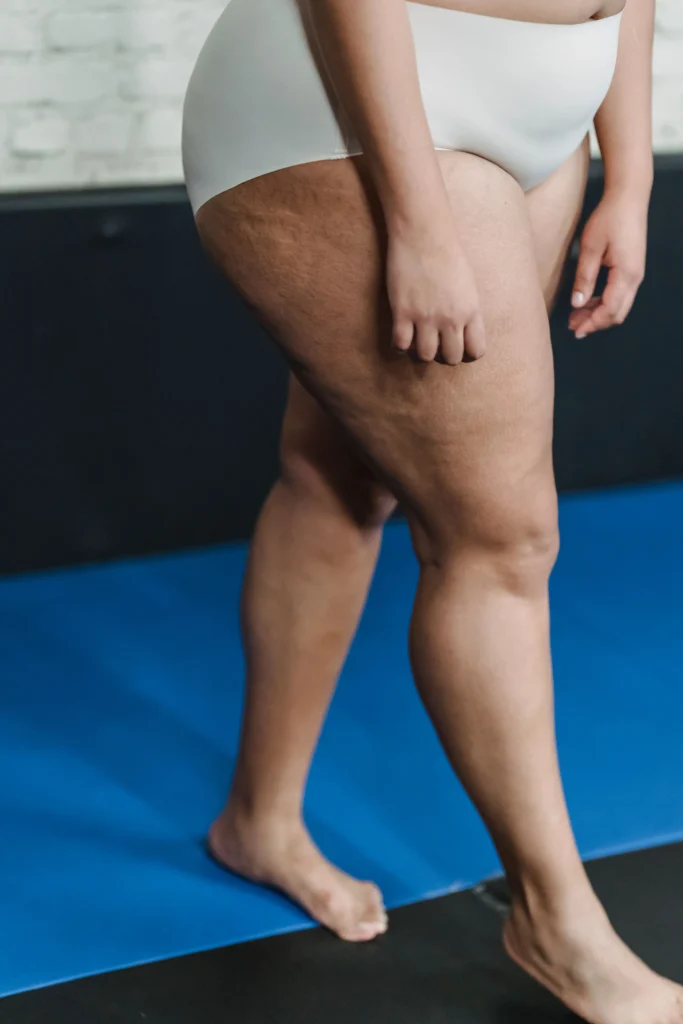 drainage cellulite fesse 1